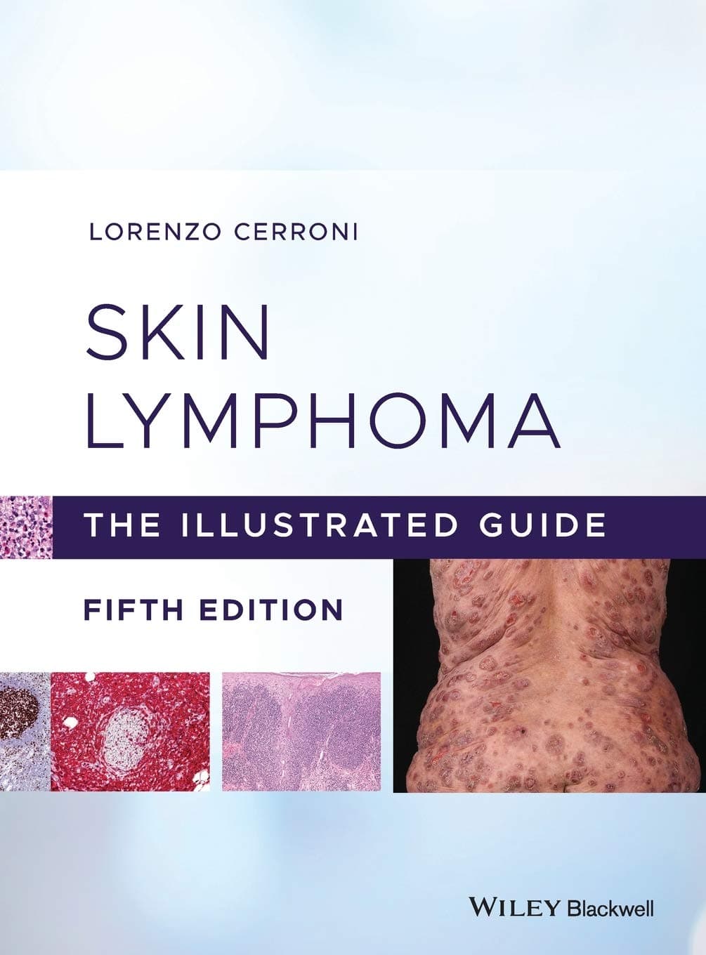 Skin Lymphoma: The Illustrated Guide